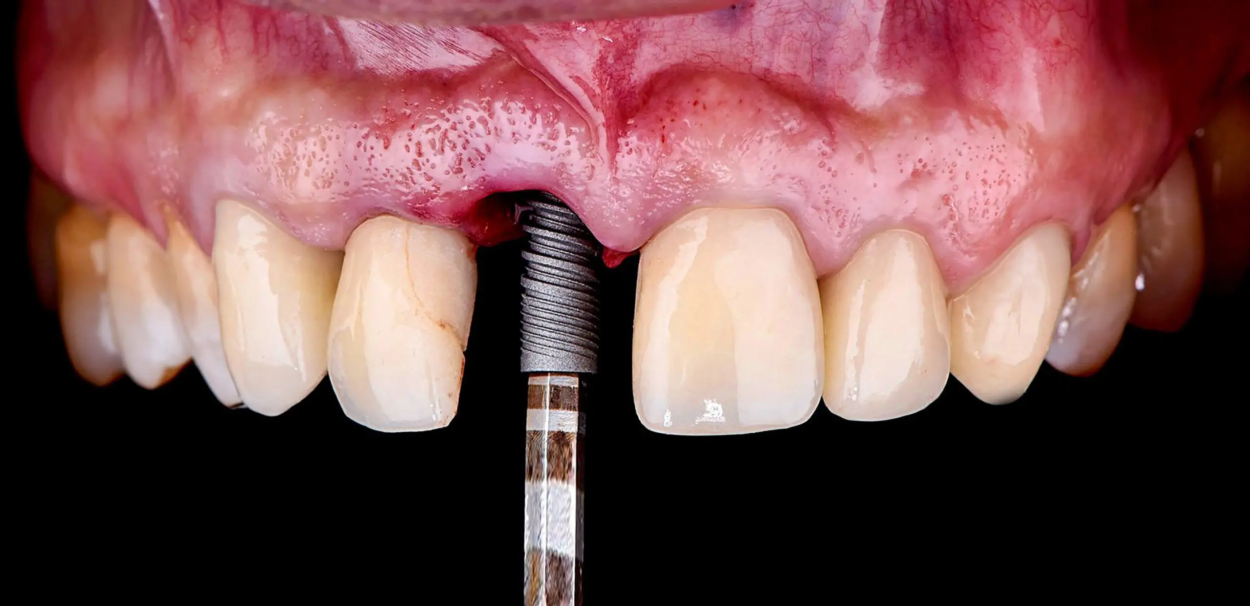 Implantes Dentários
